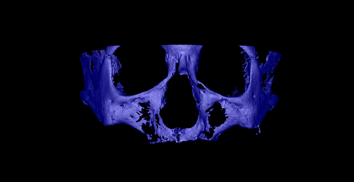 Reconstrução 3D de maxila atrófica, estudo de caso
