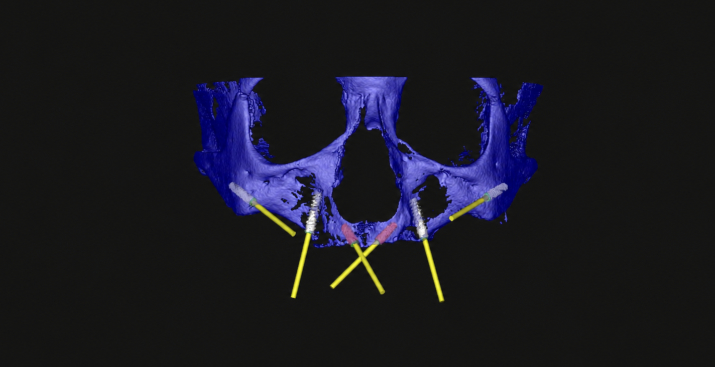 Planejamento virtual de implantes zigomáticos