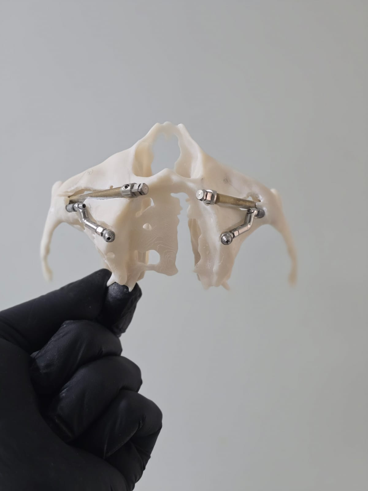 Prototipagem 3D da maxila com guia cirúrgico